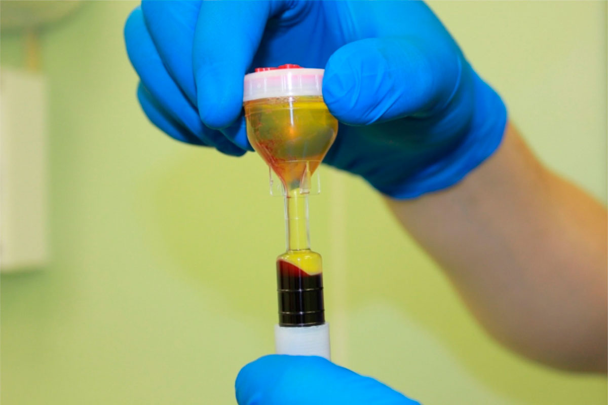 Особая техника обработки лунки удалённого зуба сгустком плазмы крови Особая техника обработки лунки удалённого зуба сгустком плазмы крови